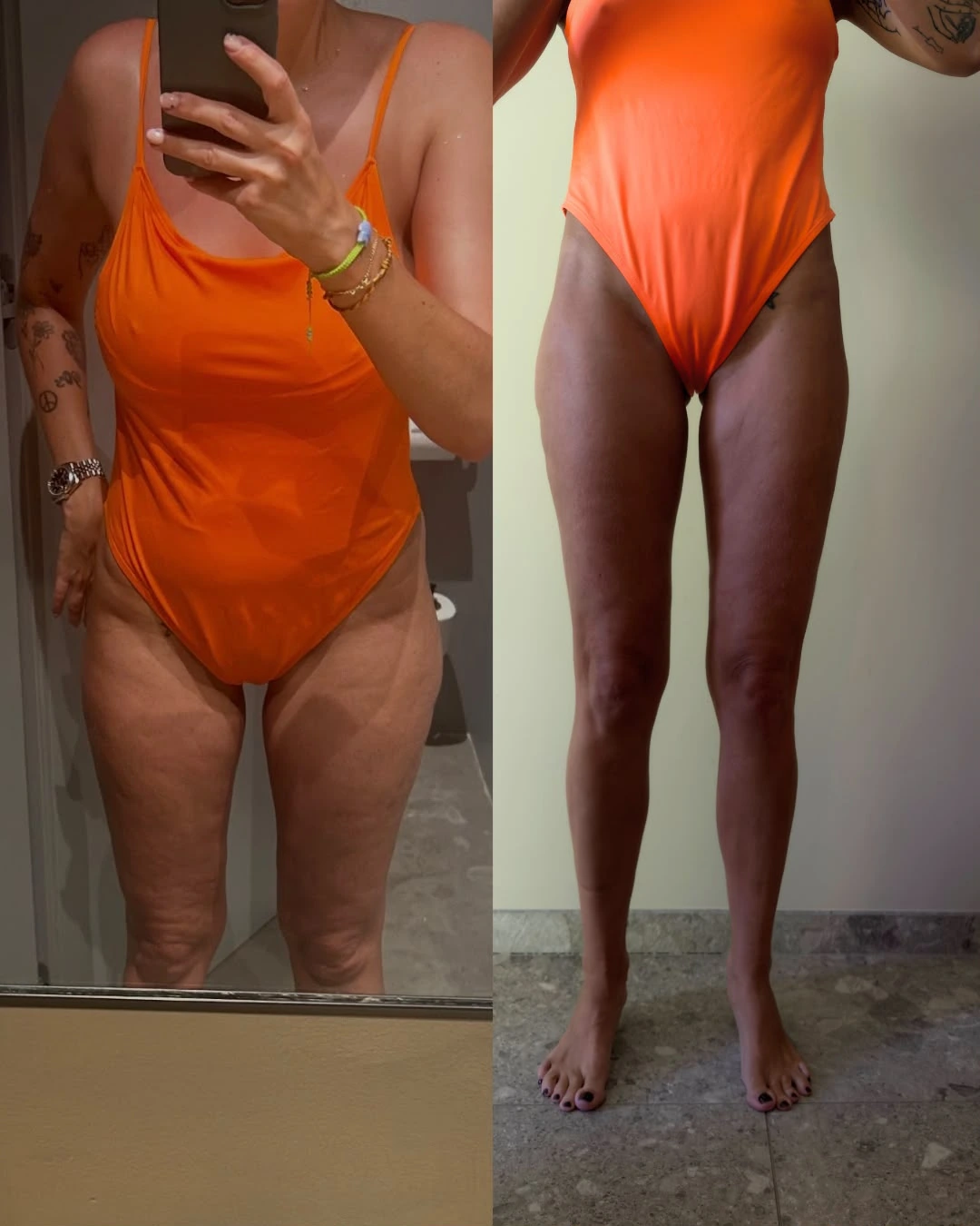 Voor-en-na-ervaring van cliënt met LPG Endermologie bij Reset Yourself, vooraanzicht