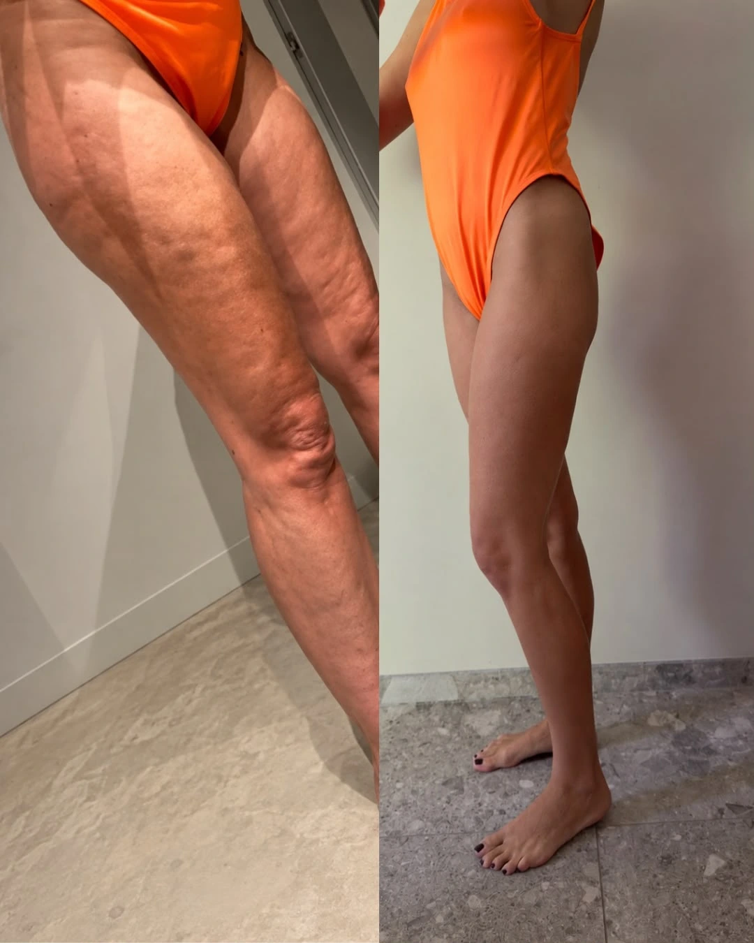Voor-en-na-ervaring van cliënt met LPG Endermologie bij Reset Yourself, zijaanzicht