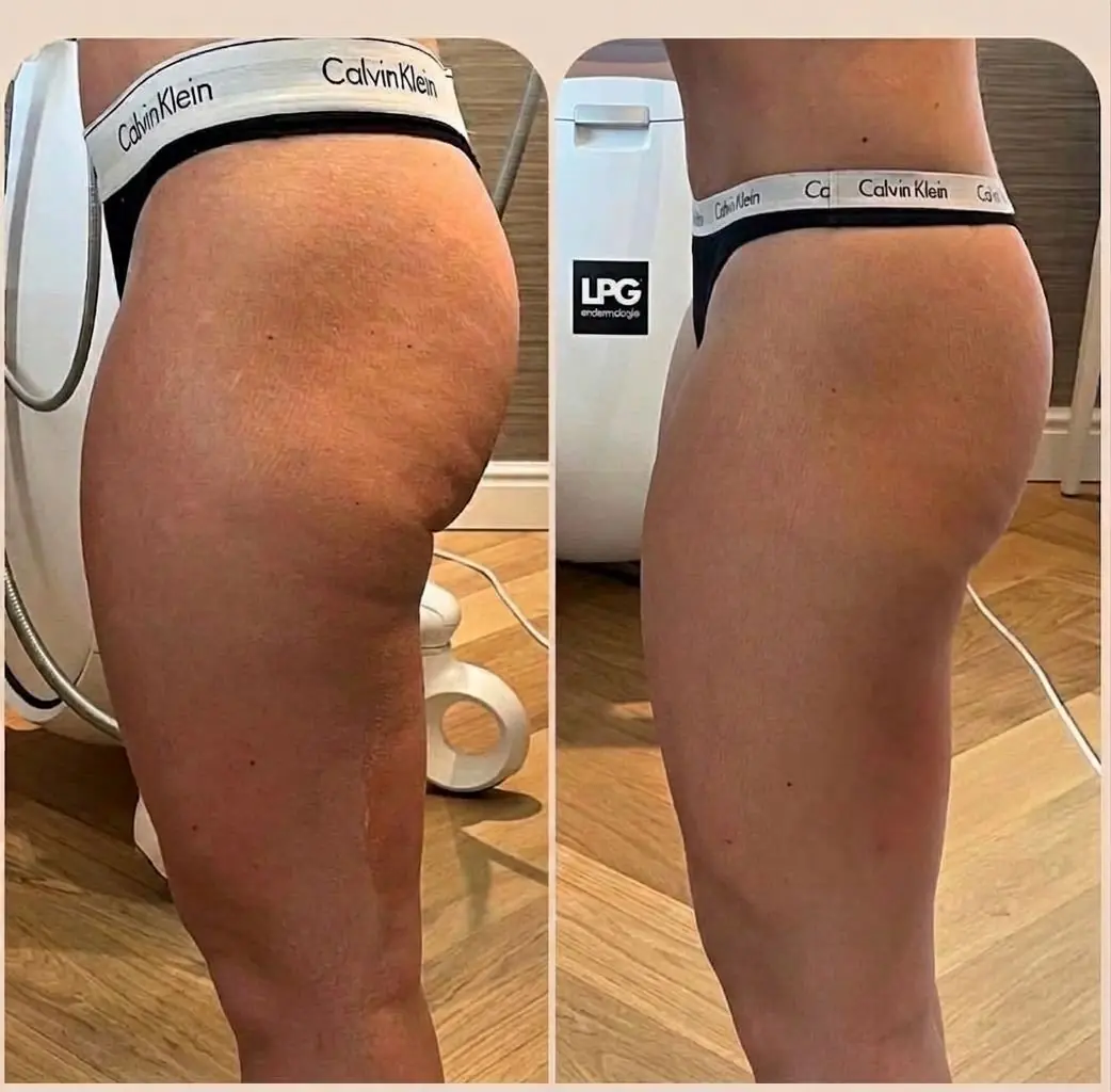 Voor en na resultaat van Sofie, 42